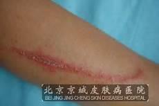 翅隐虫咬伤图片水泡